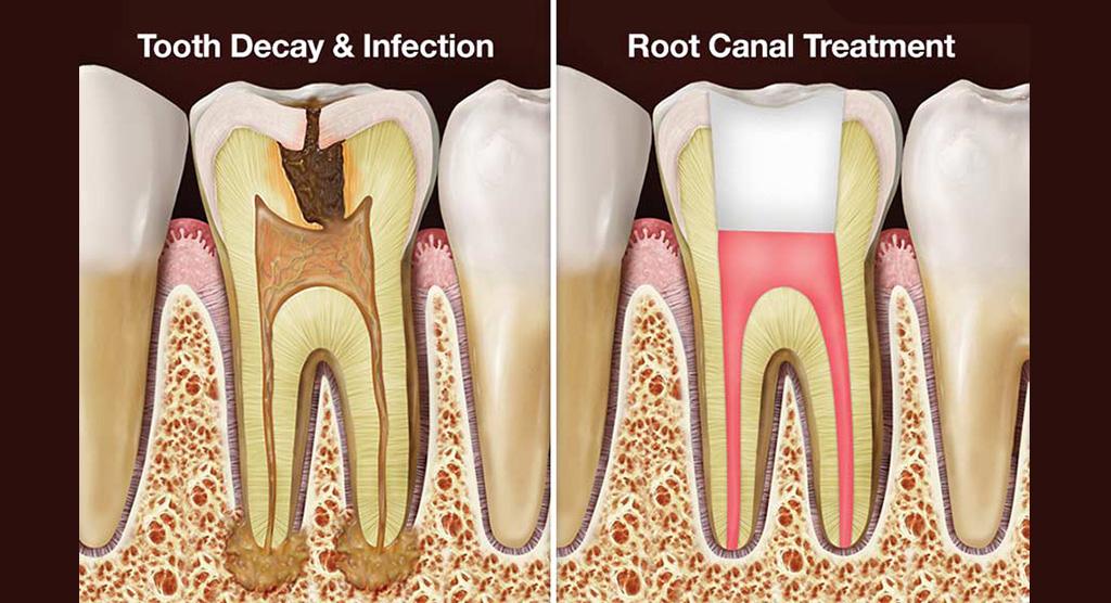 tooth-decay-and-rootcanal